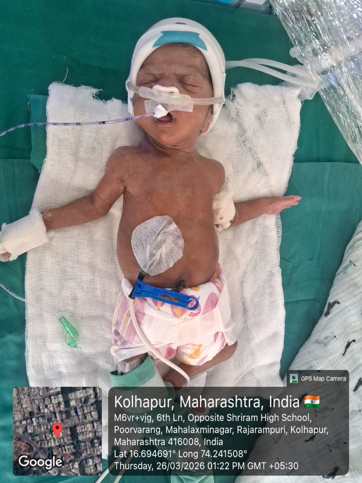 Help Premature Baby Fight for Life | NICU Emergency Case Kolhapur