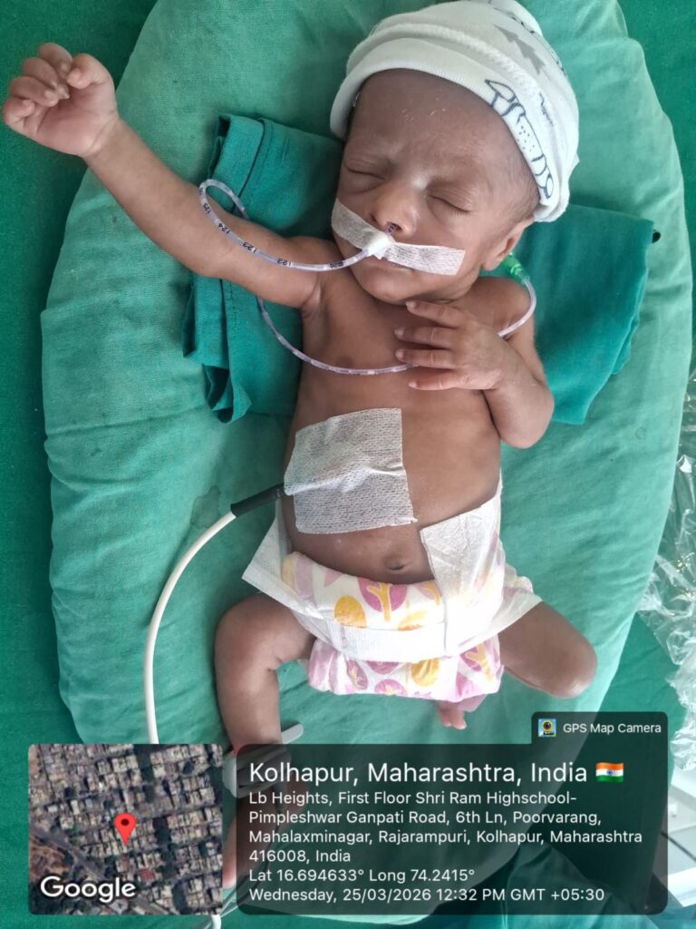 Baby of Savita Dhanaji Chavan was born prematurely at 28 weeks