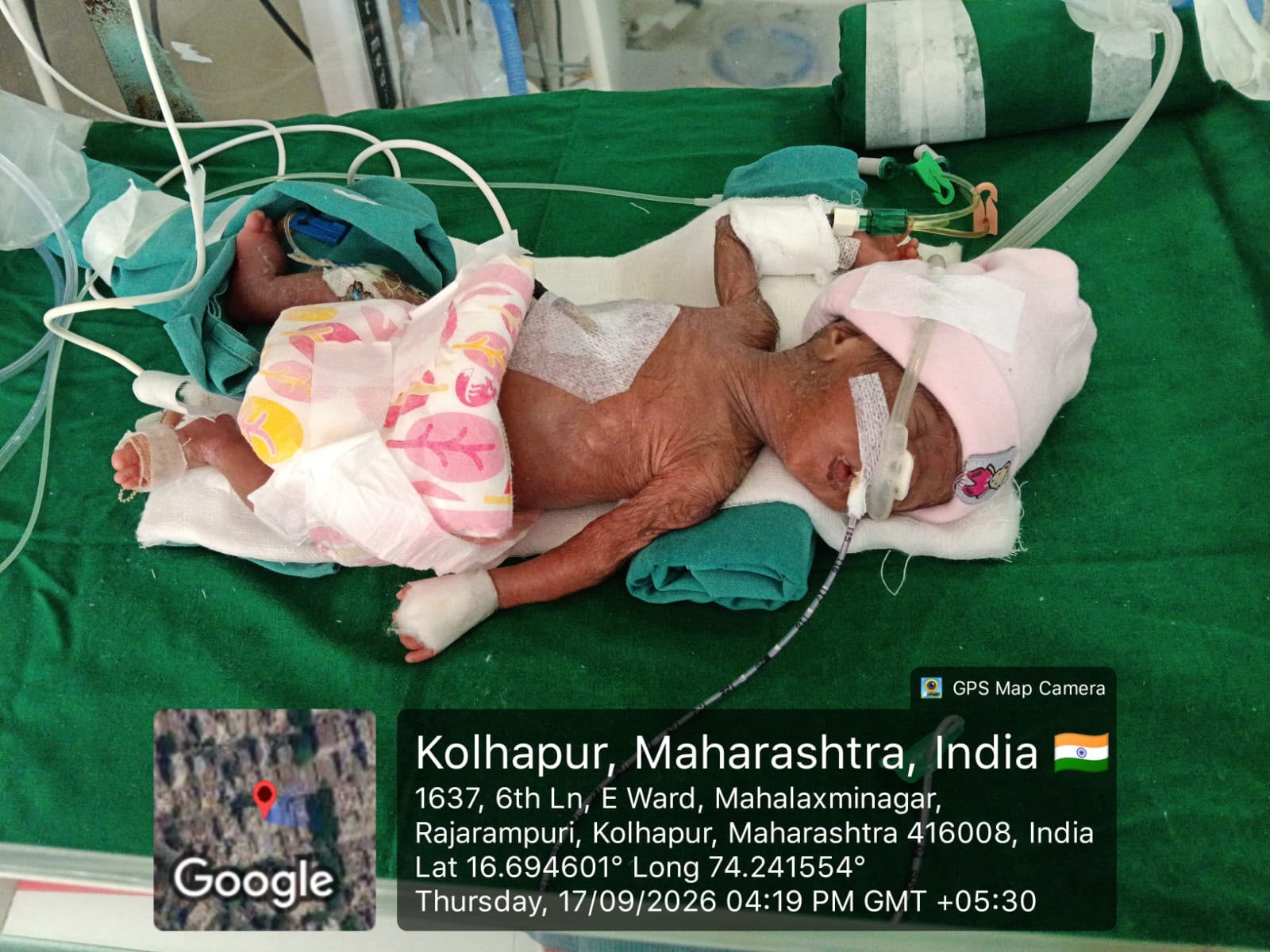 Help Save a 660-Gram Newborn Fighting for His Life in NICU