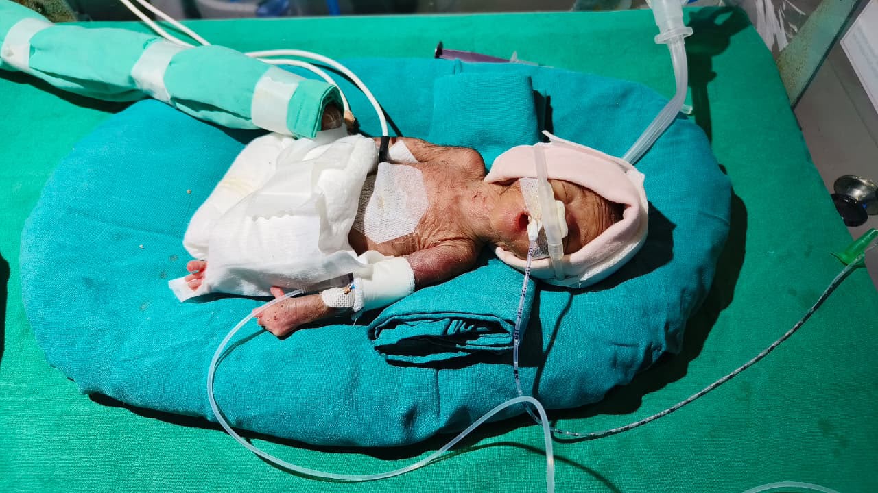 Help Save a 660-Gram Newborn Fighting for His Life in NICU